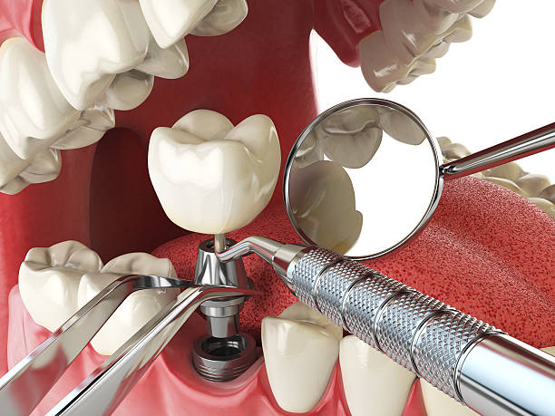 Best Emergency Root Canal Therapy in Katy, TX